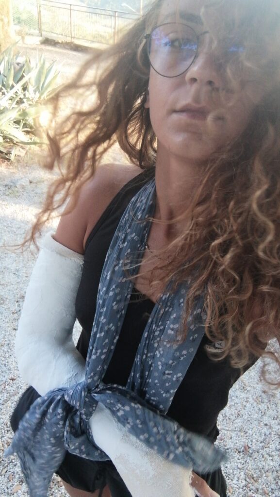 Jessica wearing a cast on her right arm